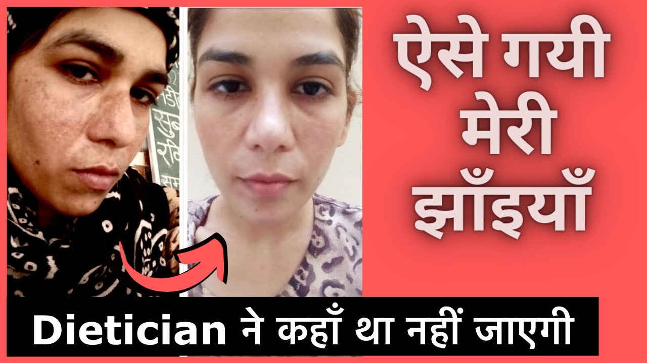 How did I cure Melasma/Pigmentation. Dietician said it will not cure. पर आपकी Diet से चली गयी झाइयाँ