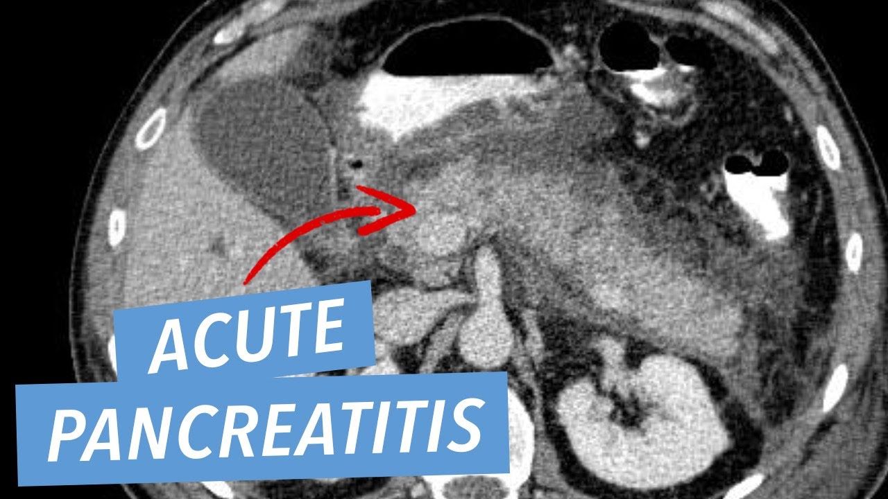 Acute Pancreatitis and Complications on CT