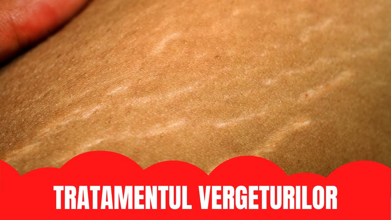 TRATAMENTUL VERGETURILOR!