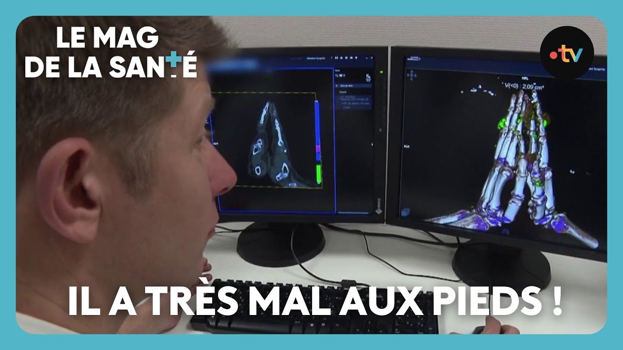 Comment soulager la goutte ?