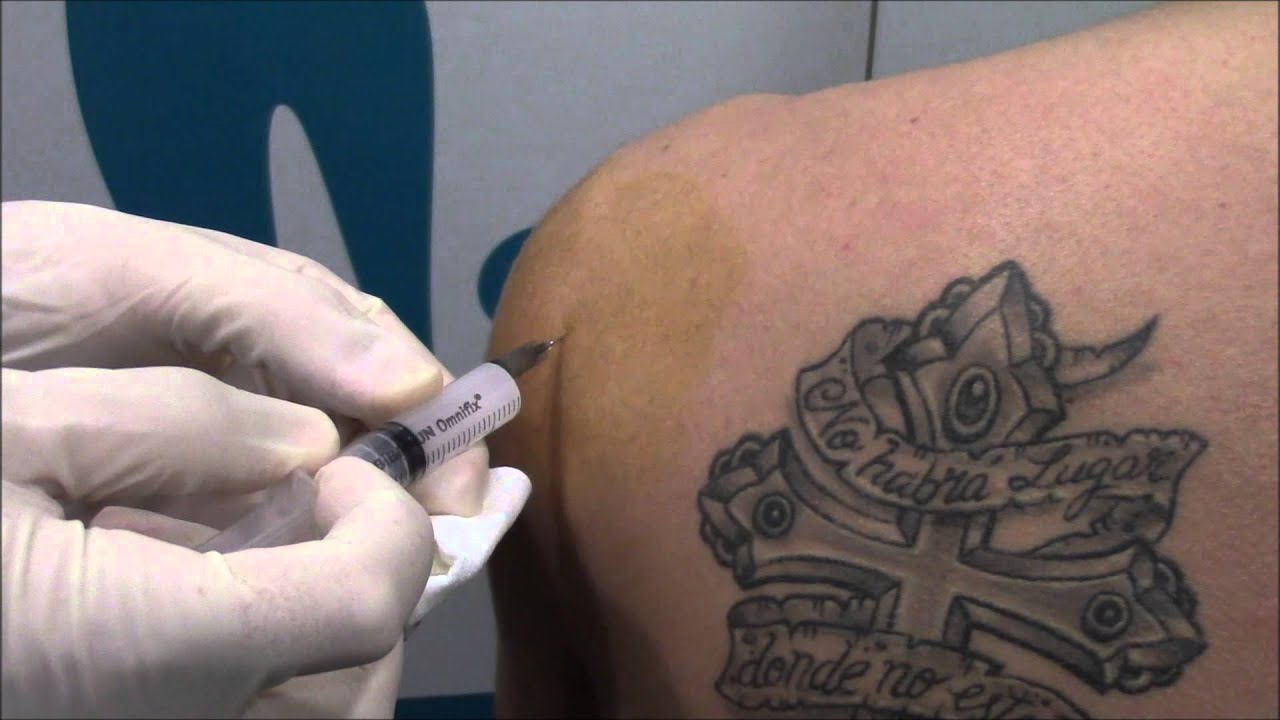 INFILTRACIÓN DE HOMBRO - Tendinitis manguito rotador