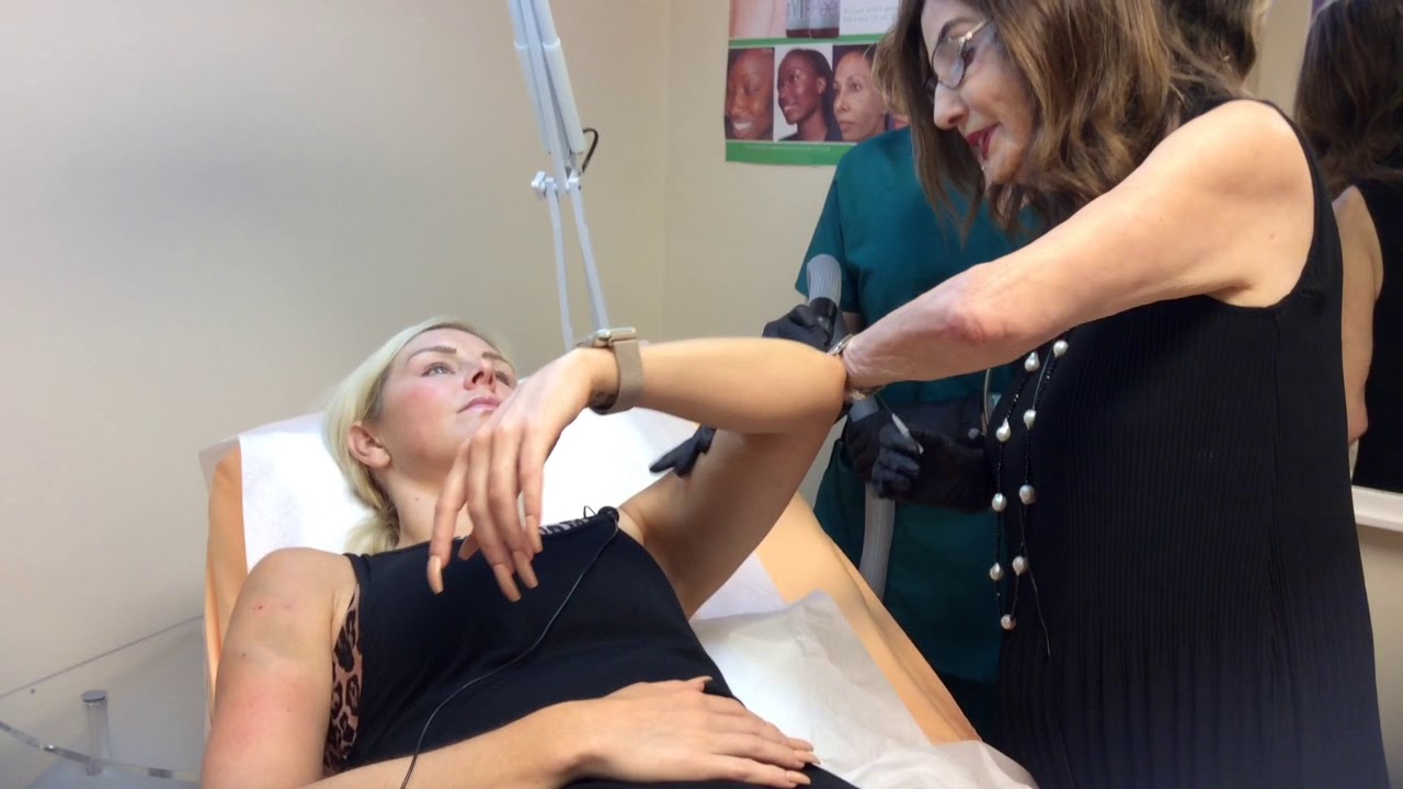 PDO Threads in the Arms to Correct Sagging