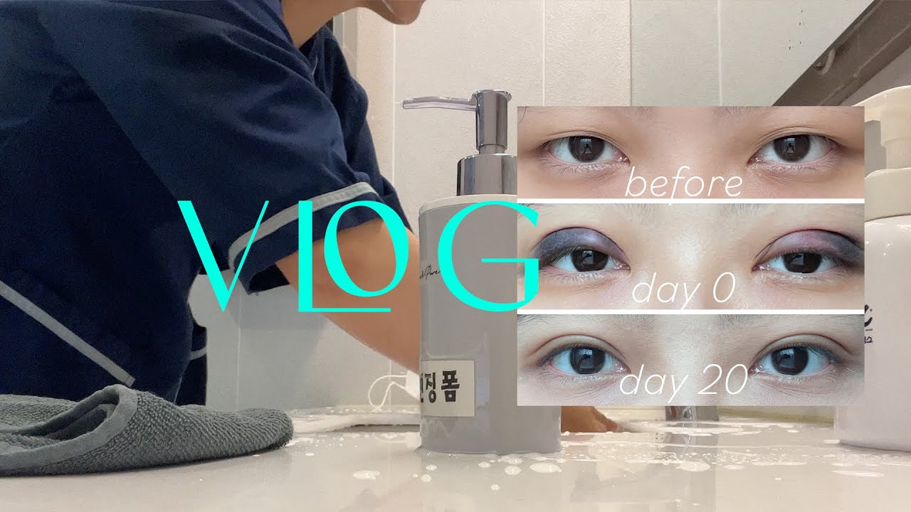 韓國vlog🇰🇷 ｜終於在韓國割雙眼皮了👀 手術前到拆線當日的恢復紀錄