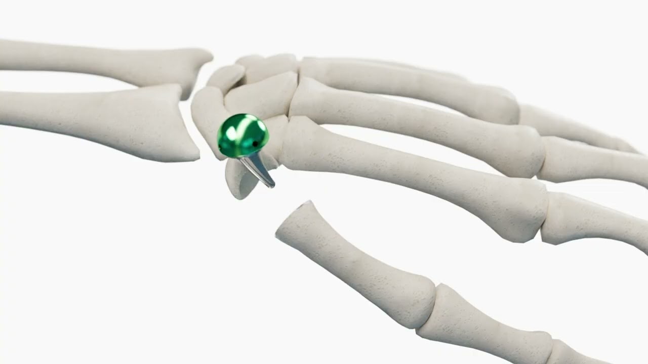 BioPro Modular Thumb Implant Joint Replacement Surgery Animation