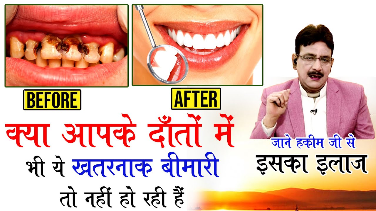 कमजोर दांतो के लिए आप हैं जिम्मेदार !|आज से ही यह 6 चीजें खाना शुरु कर दें | Hakim Suleman Khan