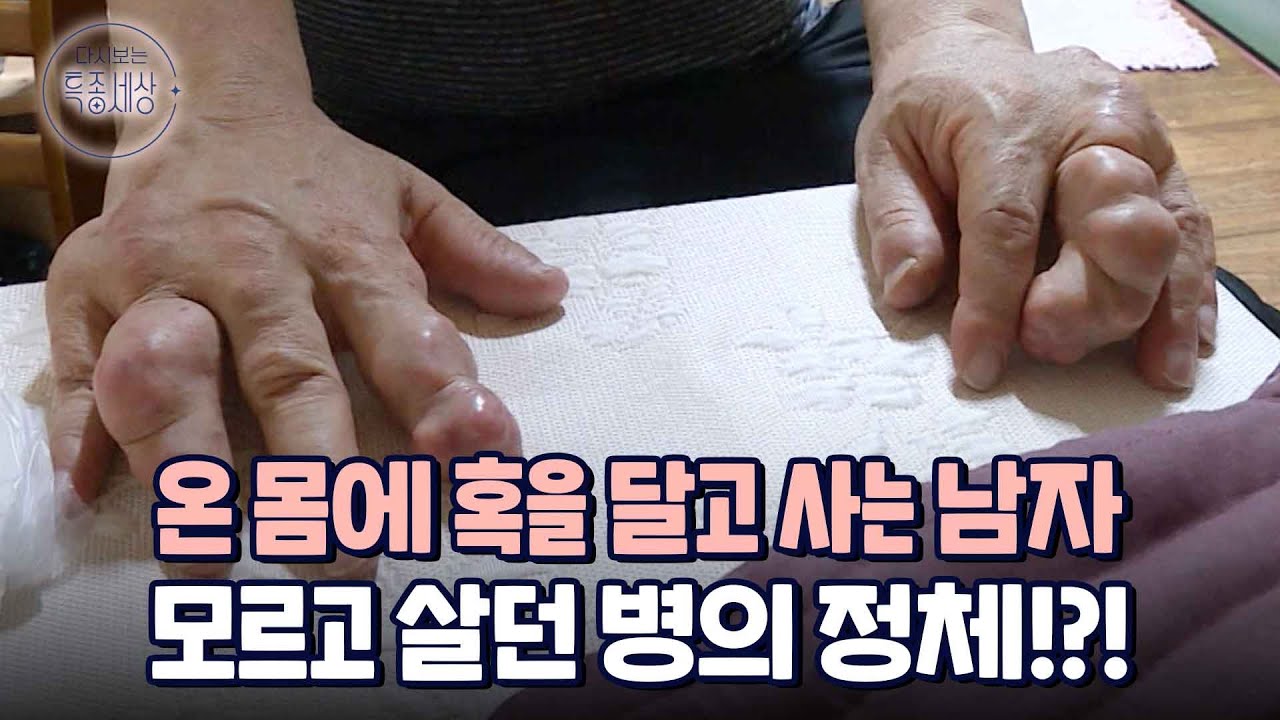 손 발이 울퉁불퉁 .. 온 몸에 혹을 달고 사는 남자? 몰랐던 병의 정체, 고칠 수 있을까?｜다시보는 특종세상 375회