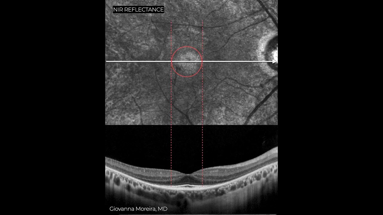 RETINITIS PIGMENTOSA MACULAR MULTIMODAL ANALYSIS For more images like this visit www.retinography.or