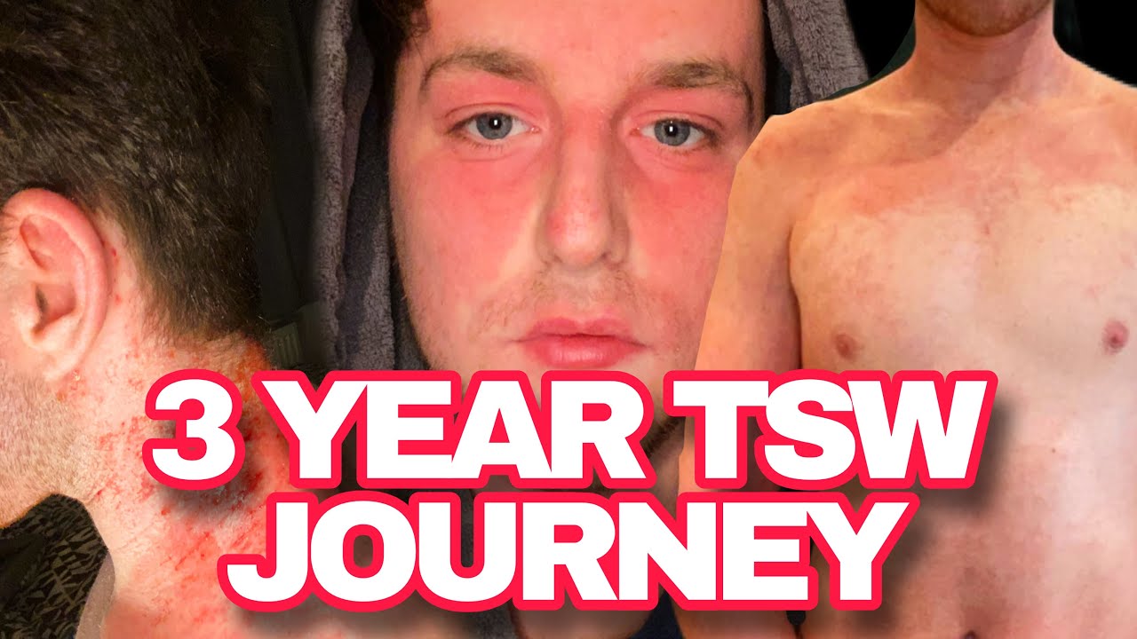 MY 3 YEAR TOPICAL STEROID WITHDRAWAL JOURNEY