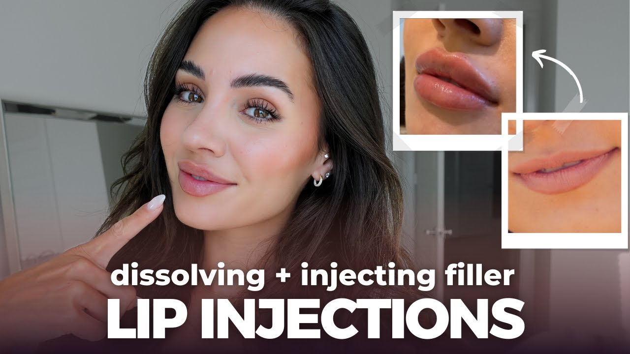 LIP INJECTIONS: Dissolving and re-injecting lip filler process - all you need to know!