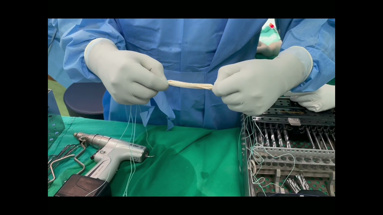 Triple bundle graft preparation technique 11 June 2021