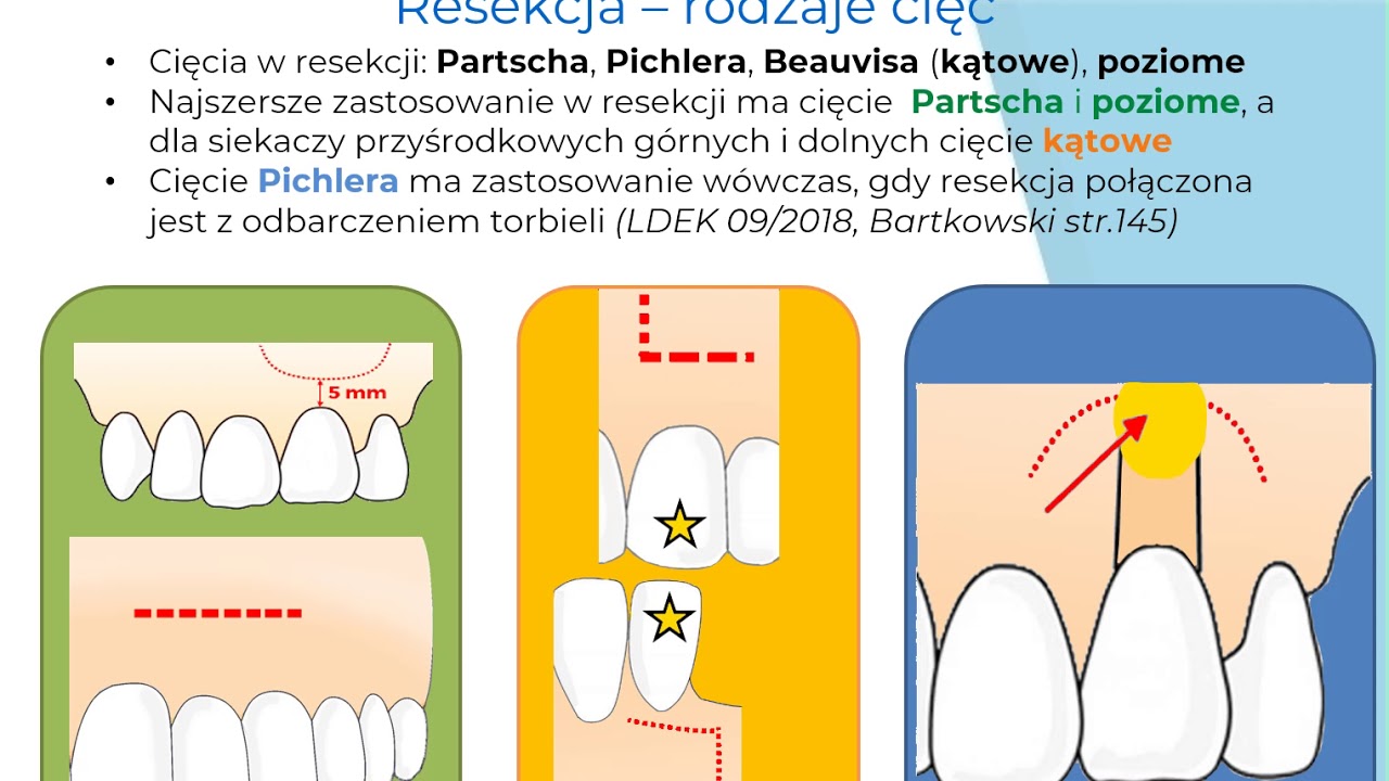 Chirurgia stomatologiczna LDEK