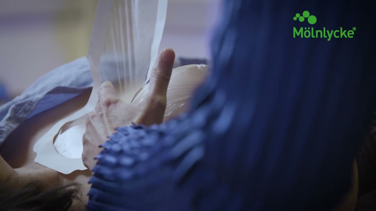 Mepitel® Film Application on Breast for Radiotherapy
