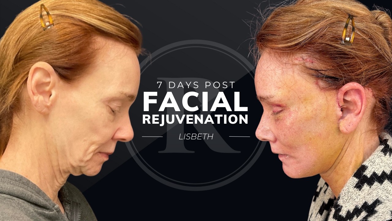Lisbeth's Story: 7 Days Post Facial Rejuvenation