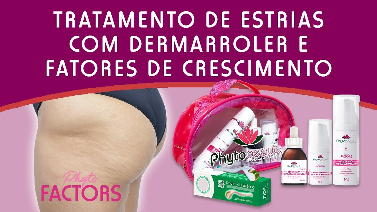 Protocolo para Estrias com Dermarroler e Fatores de Crescimento