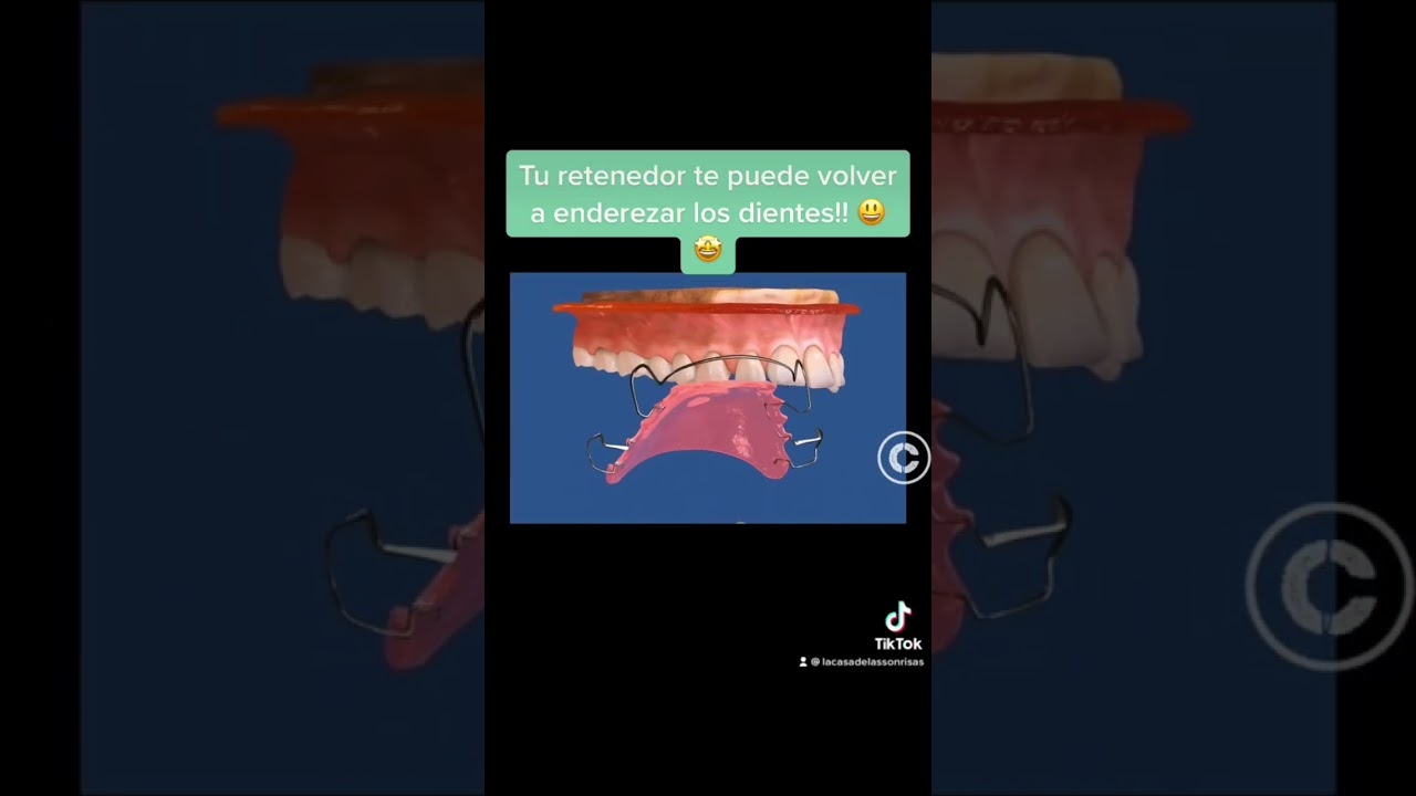 Tu retenedor te puede ayudar a enderezar dientes que se te enchuecaron!! 😍 #shorts