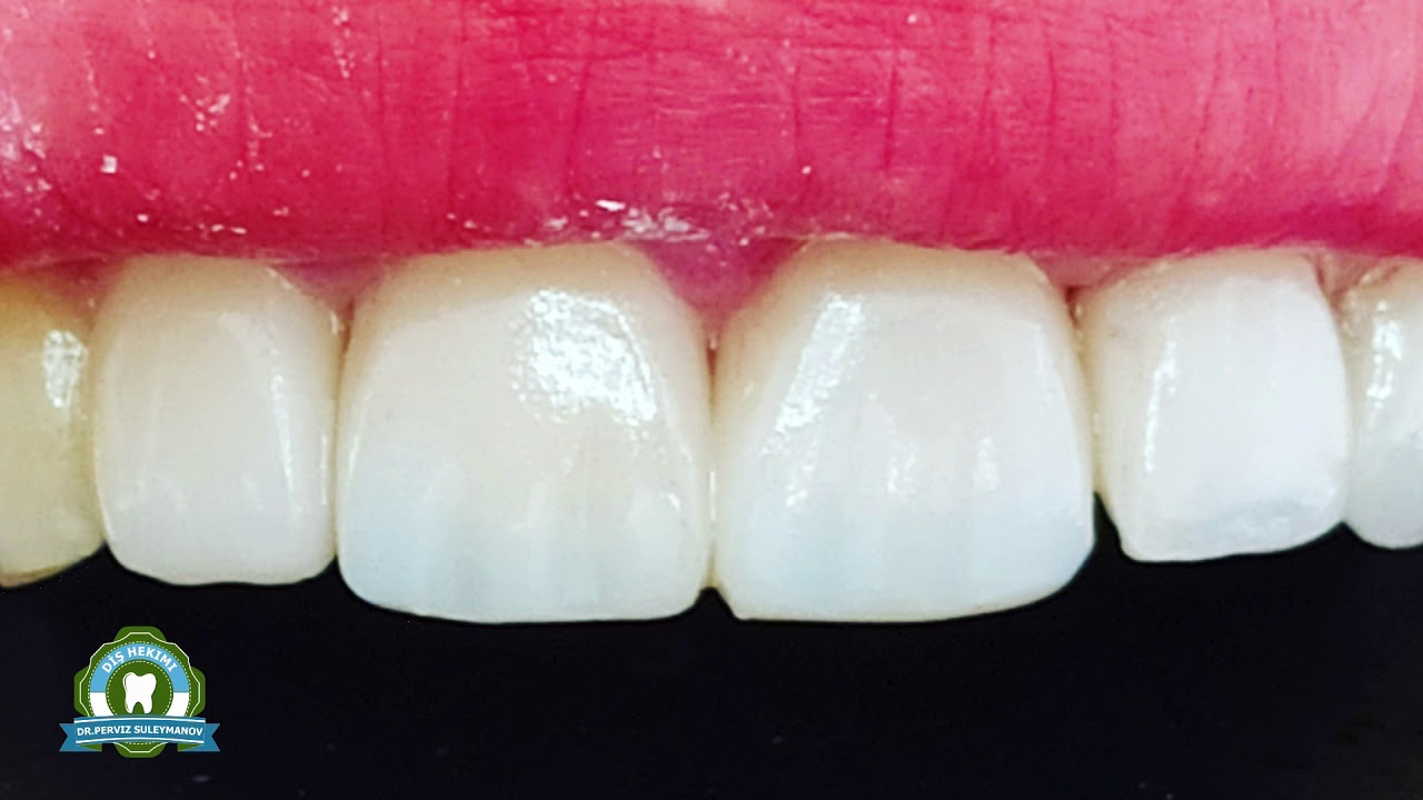 Estetik Plomb #8 - Composite Veneer