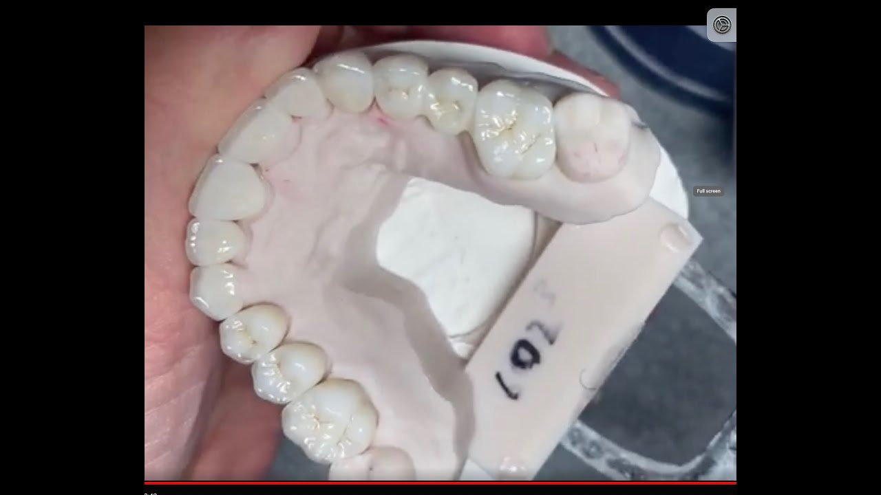 How to do Contacts and Margins on Upper #3 to #14 Facial Cutback Zirconia Singles