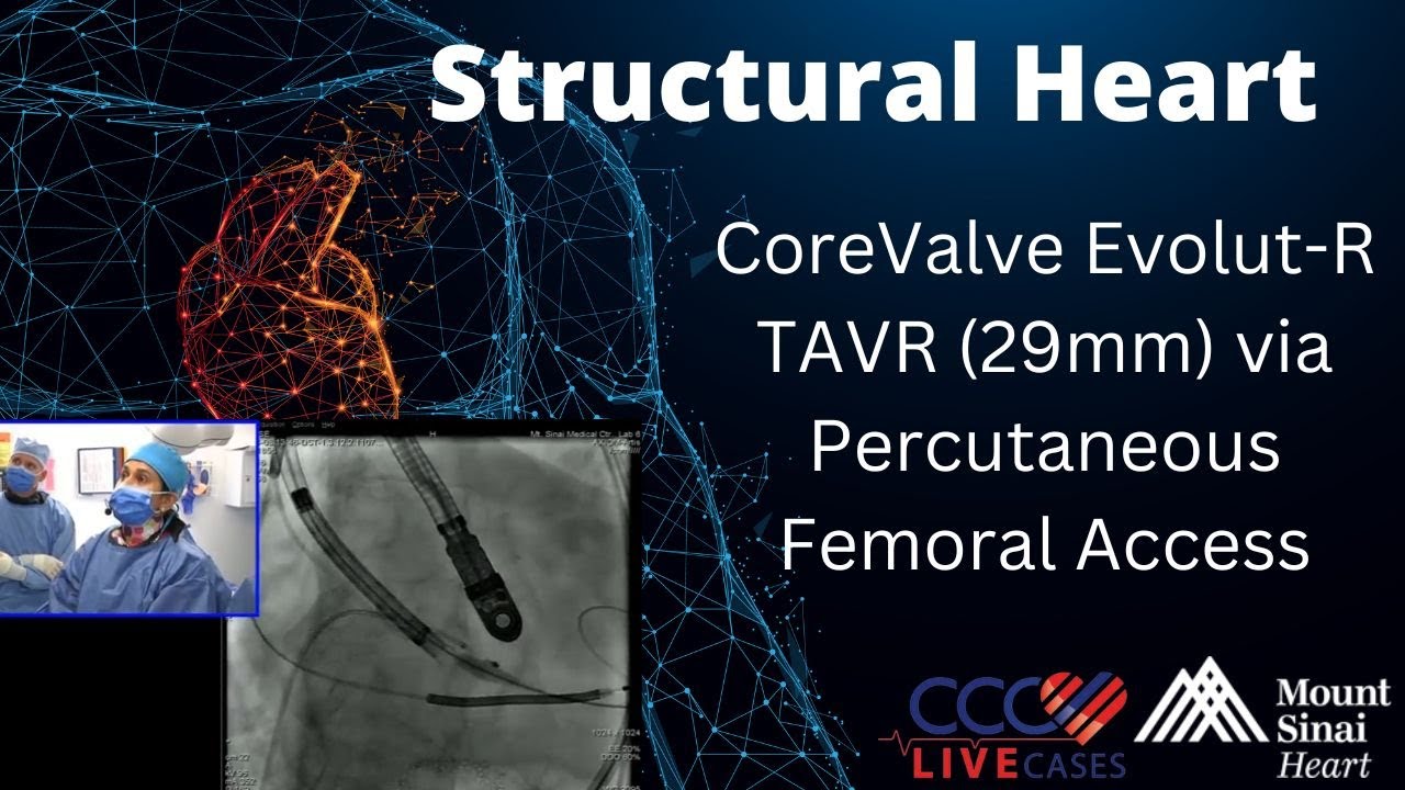 CoreValve Evolut-R TAVR (29mm) via Percutaneous Femoral Access - Structural Heart Case - June 2016