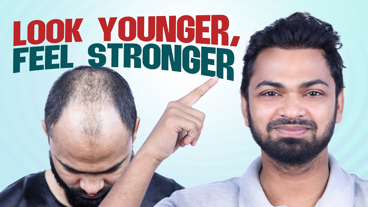 From Bald to Bold: Marine Engineer’s Journey 😍 | Hair Transplant Bangladesh | New Roots