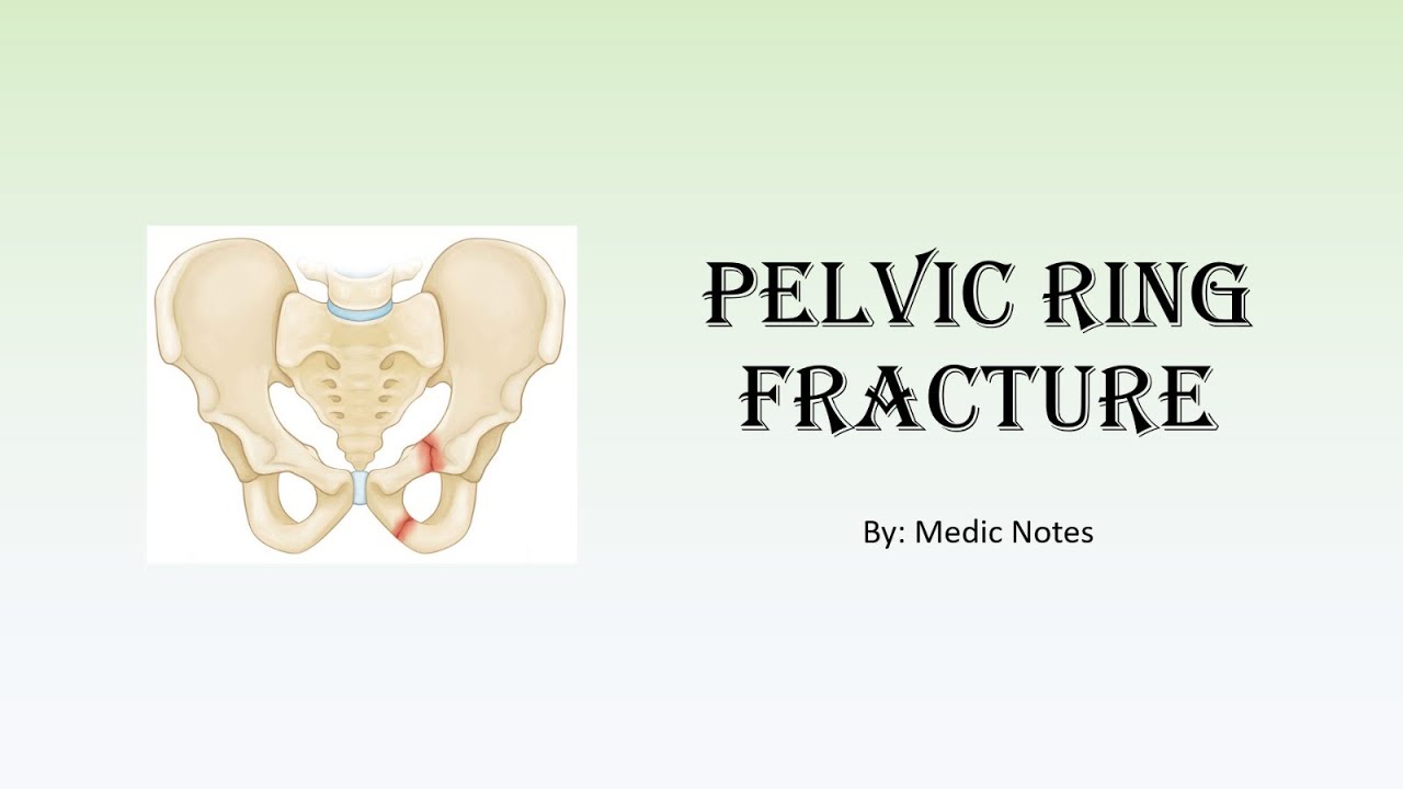 Pelvic ring fracture - Tile & Young Burgess classification, signs and symptoms, treatment options