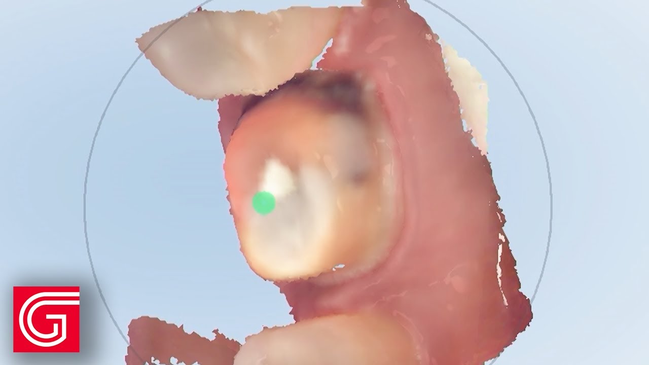 How to Accurately Scan a Lower Molar Preparation