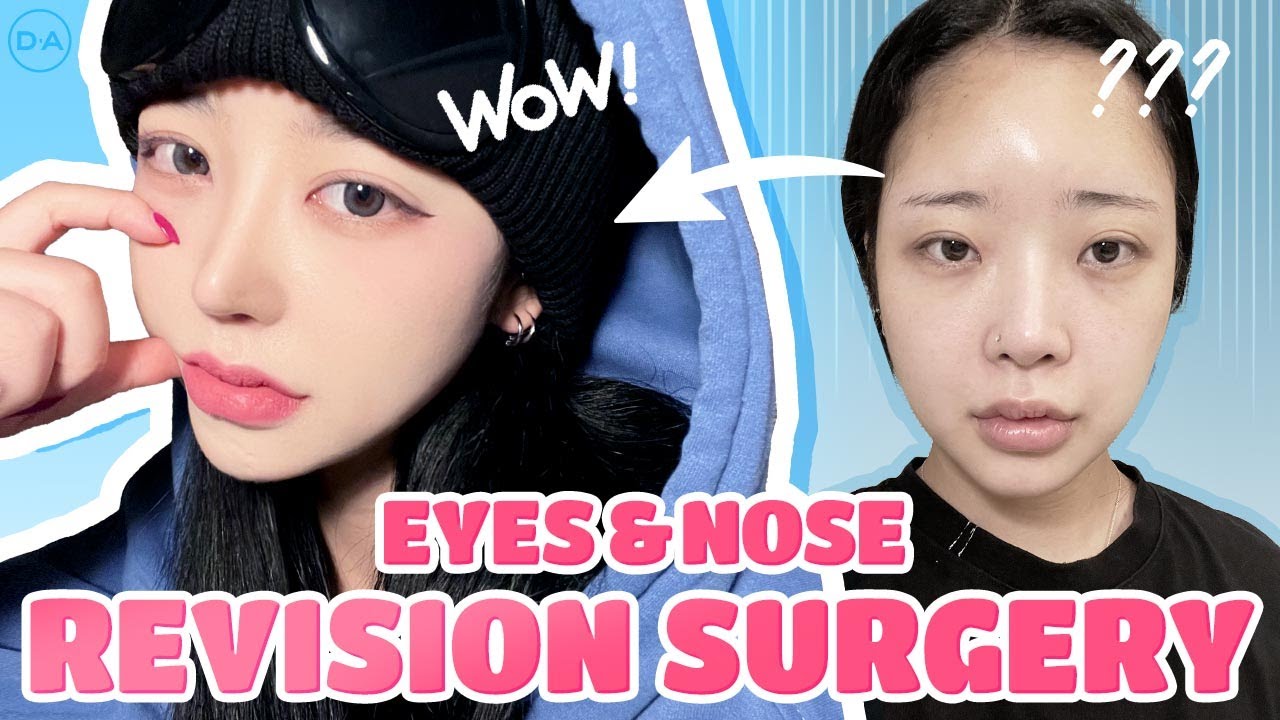 [Plastic Surgery Korea] Eyes & Nose Revision Surgery