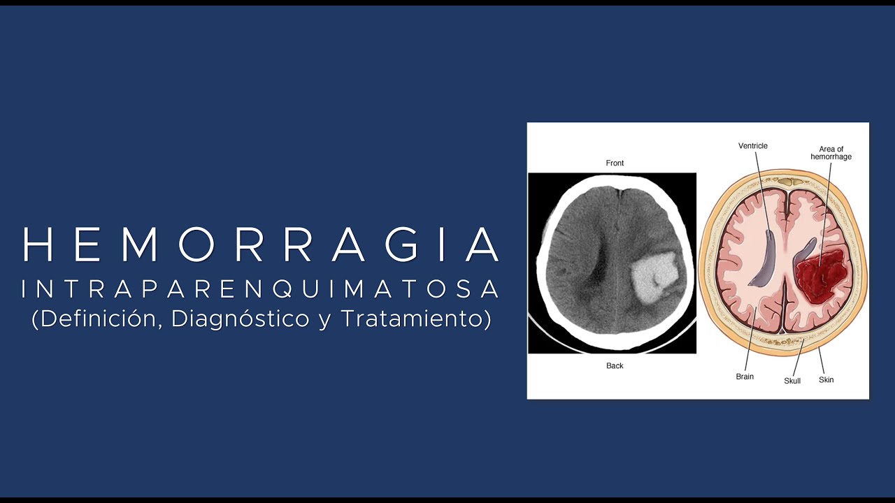 #Hemorragia #Intraparenquimatosa y #Subaracnoidea