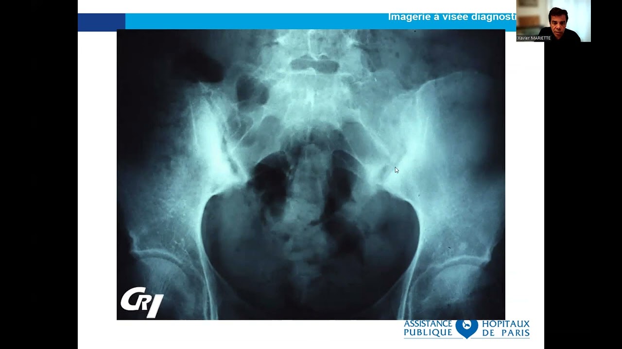 Spondyloarthrite par le Dr Stephan PAVY du service Immuno-rhumatologie de l'Hopital Bicetre AP-HP