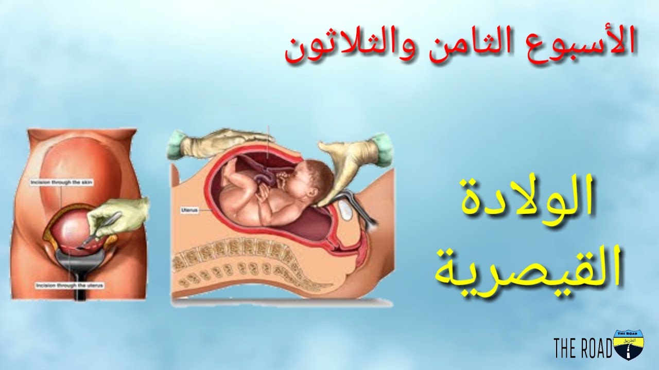 الاسبوع الثامن والثلاثون من الحمل .. الولادة القيصرية