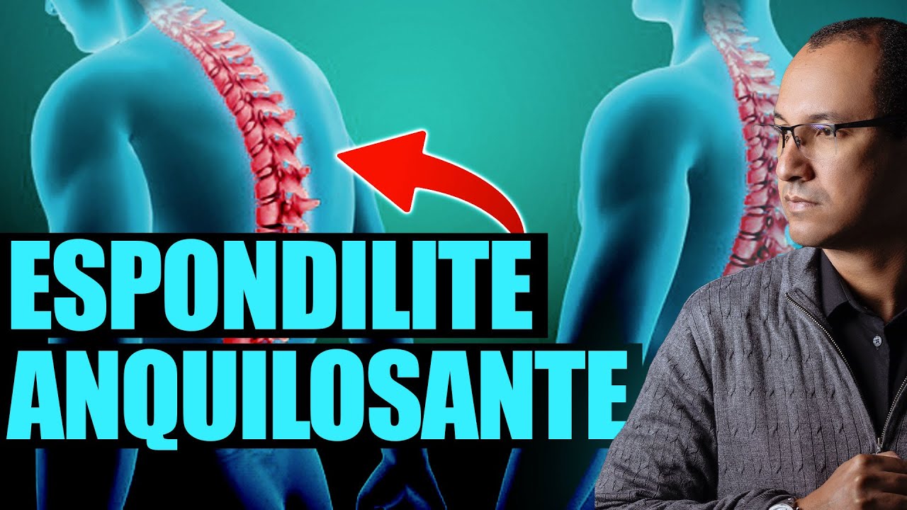 ESPONDILITE ANQUILOSANTE: SINTOMAS, CAUSAS E TRATAMENTO