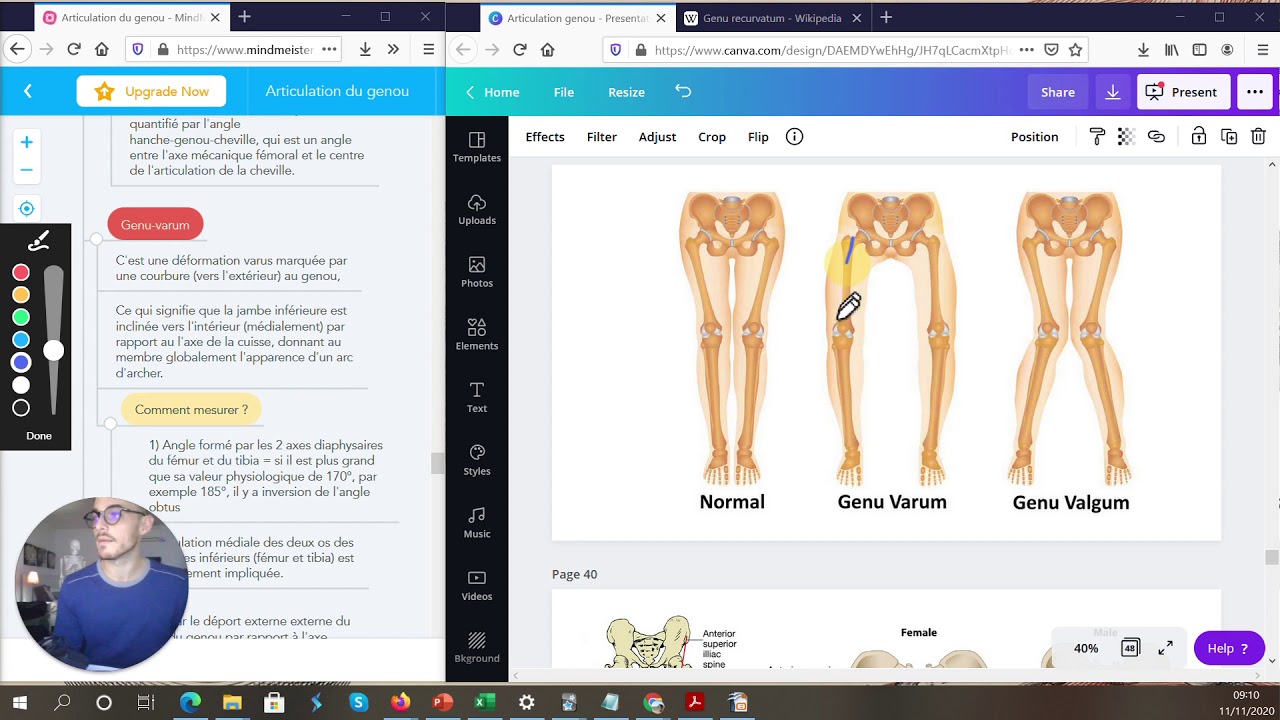 GENU VARUM, GENU VALGUM ET GENU RECURVATUM + AXE MÉCANIQUE DU MEMBRE INFÉRIEUR