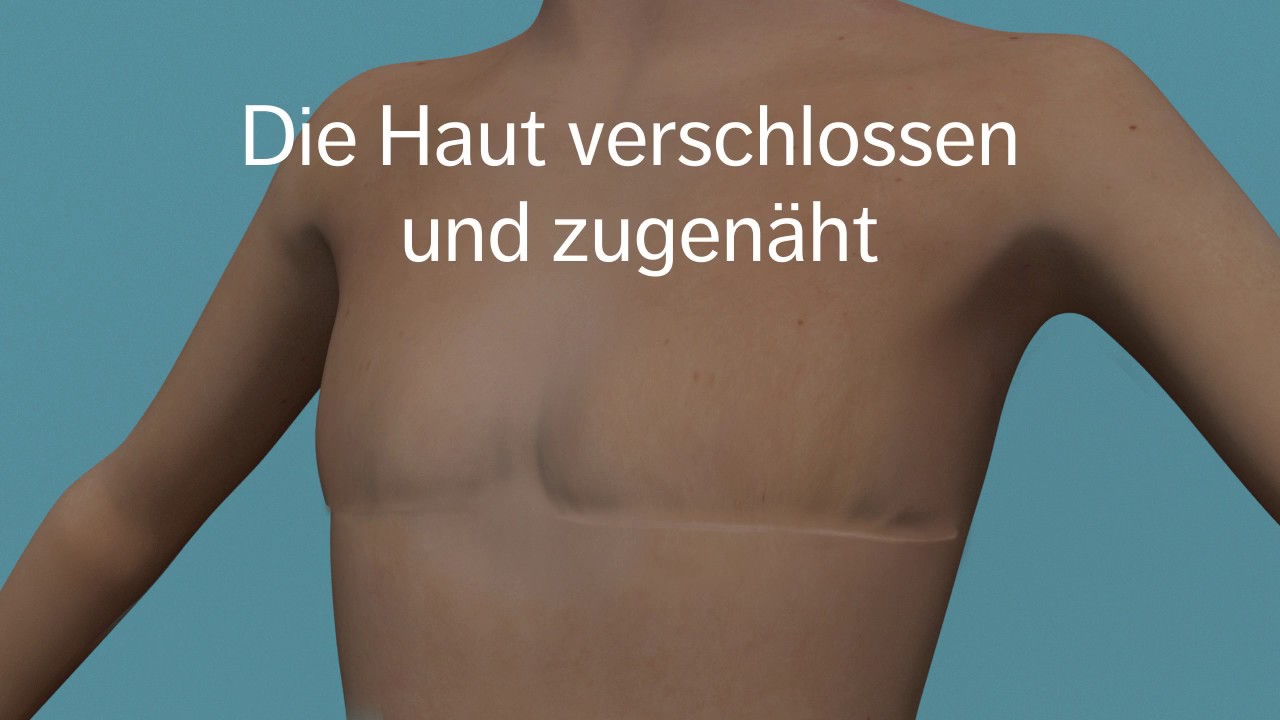 Mastektomie bei einer großen Brust