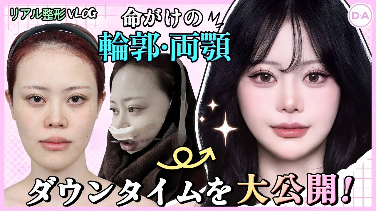 ［韓国整形］命がけの手術、ダウンタイムを大公開！［DA美容外科］