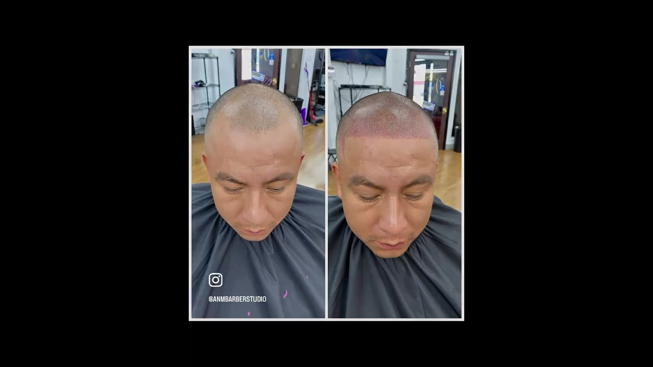 Smp scalp micro pigmentation.. Best solution for hair loss.. Arlington Tx