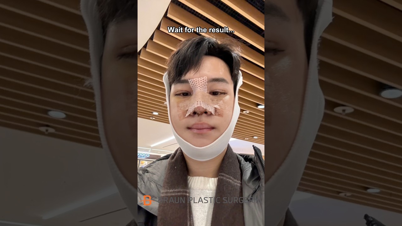 So I cut my jaw in Korea&hellip;🤯 #fyp #glowup #beforeandafter #facialcontouring #rhinoplasty #idol #viral