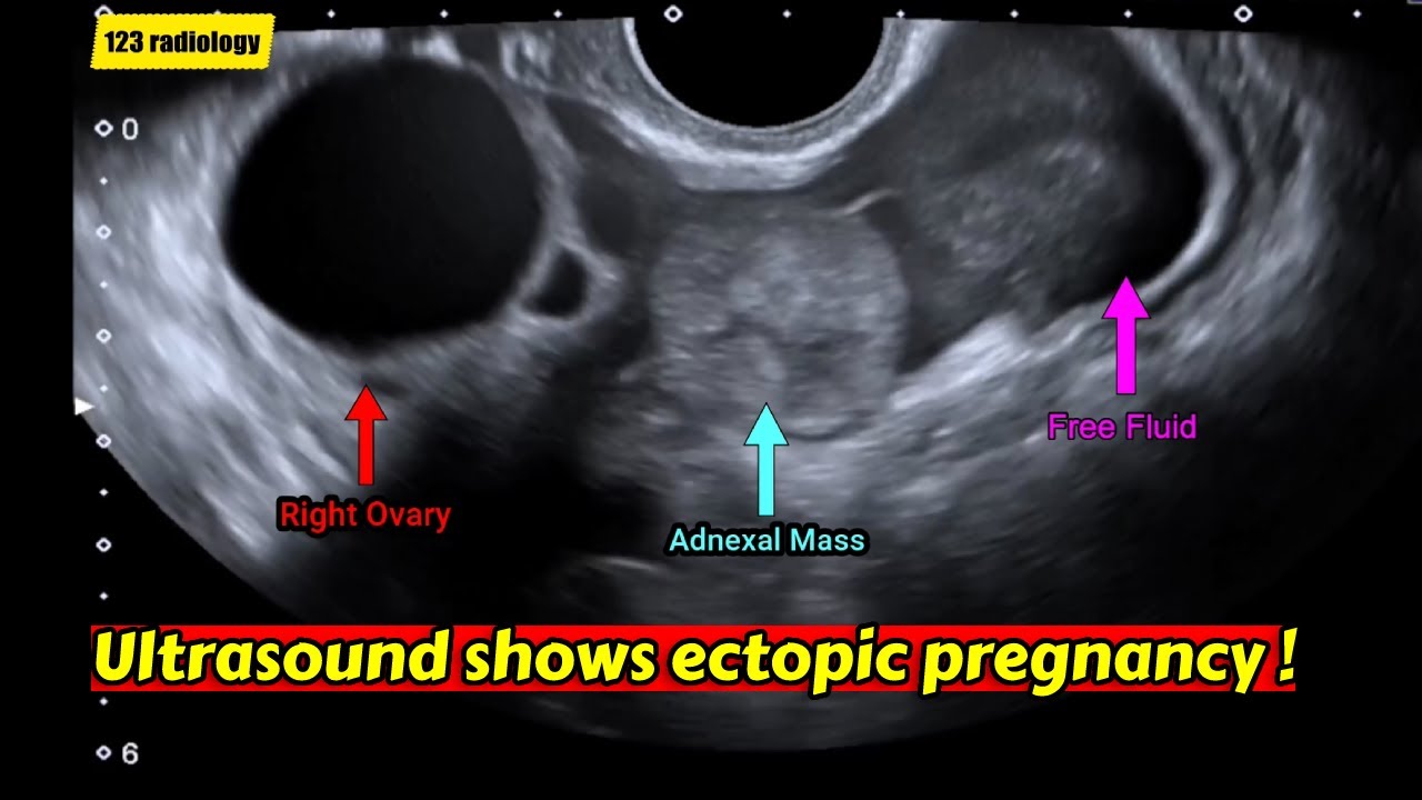 Ectopic Pregnancy | Ultrasound case