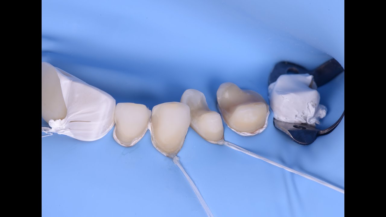Multiple Onlays/Veneers adhesive cementation