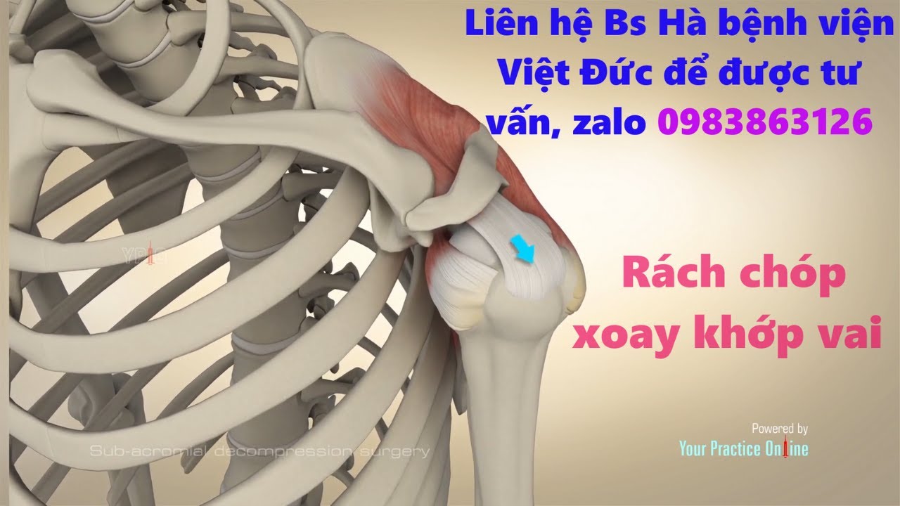 RÁCH GÂN CƠ CHÓP XOAY KHỚP VAI ( RÁCH GÂN TRÊN GAI ) - CHẨN ĐOÁN , ĐIỀU TRỊ