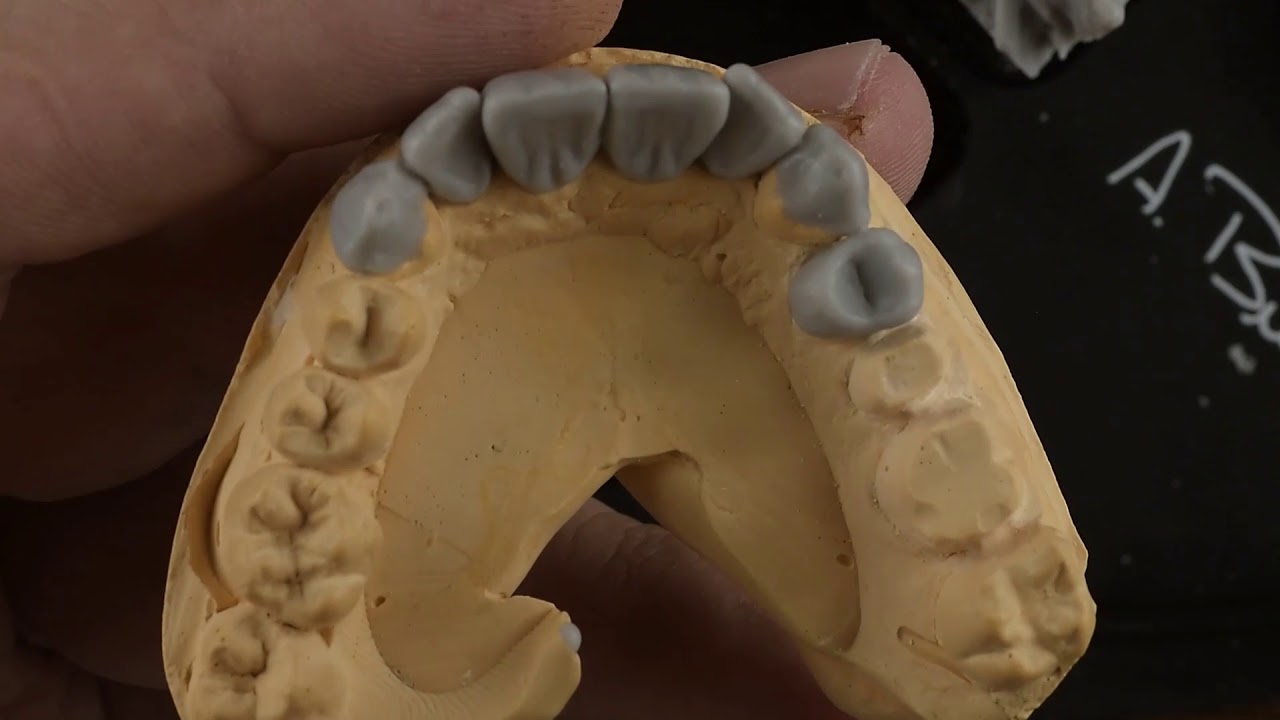 Wax up upper premolar تشميع الضاحك الأول العلوي