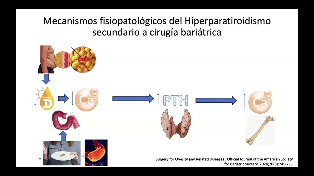 Prevención de pérdida ósea después de cirugía bariátrica