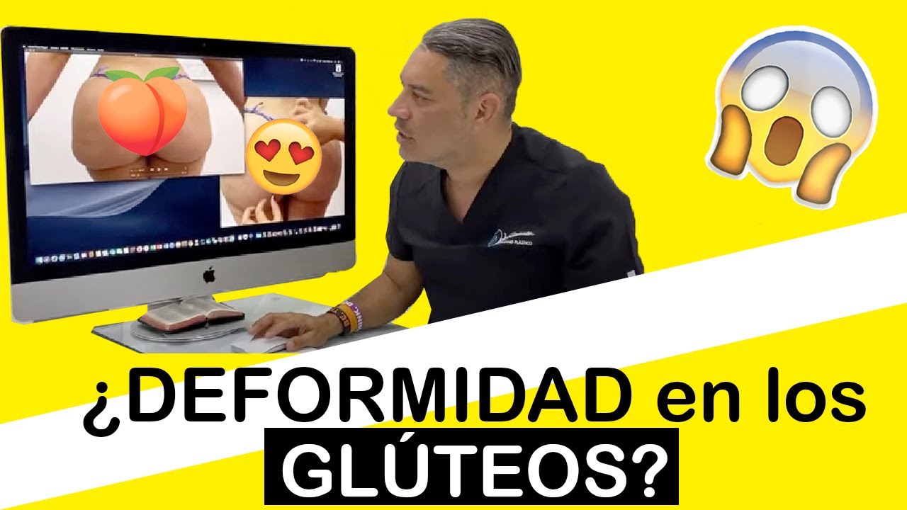 #28 | 🍑 ¿FUNCIONA el J PLASMA en los GLÚTEOS? 🍑 Asimetría Glútea con RENUVION ► Dr John Garcia