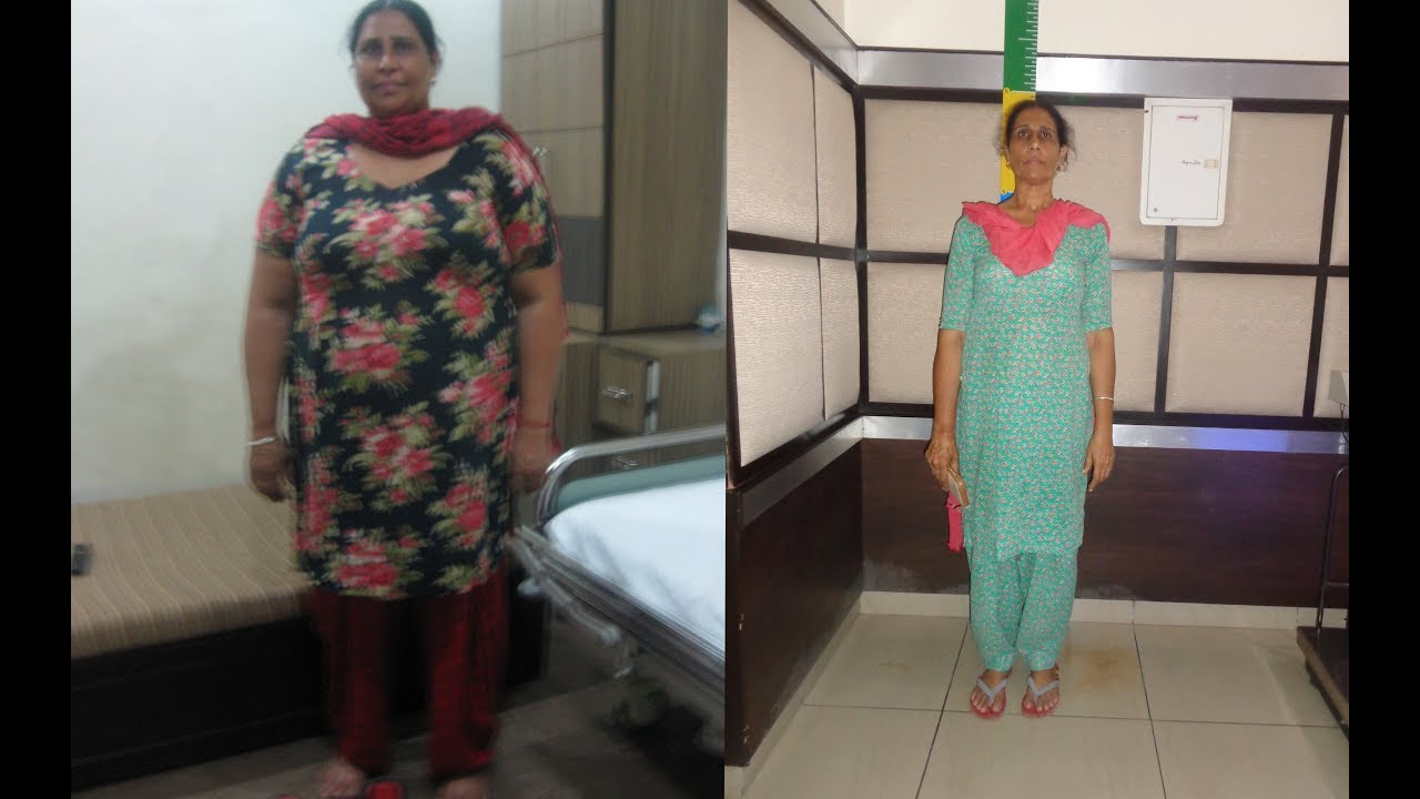 Best Weight loss Surgeon in Punjab | India | Lost 56 kg | bariatric surgery in Punjab India