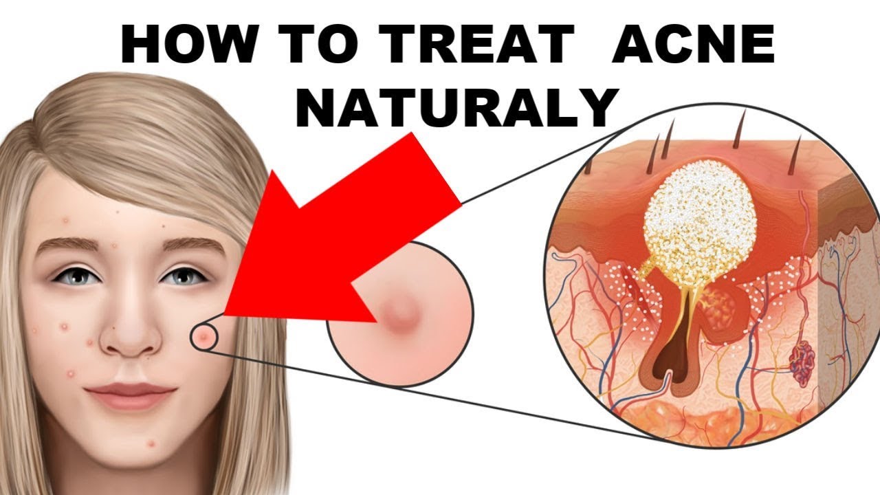 THE ROOT CAUSE OF ACNE - what dermatologists won't tell you