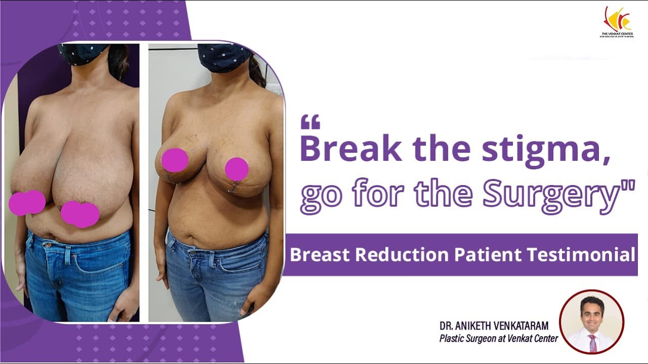 Breast Reduction Surgery Experience | Breast Size Reduction Treatment | Venkat Center