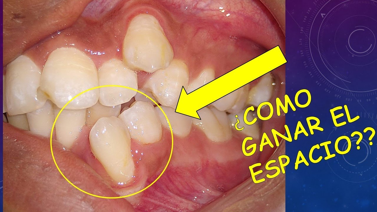 ¿Como se gana espacio para alinear dientes en la Ortodoncia, evitando quitar dientes premolares? 😎