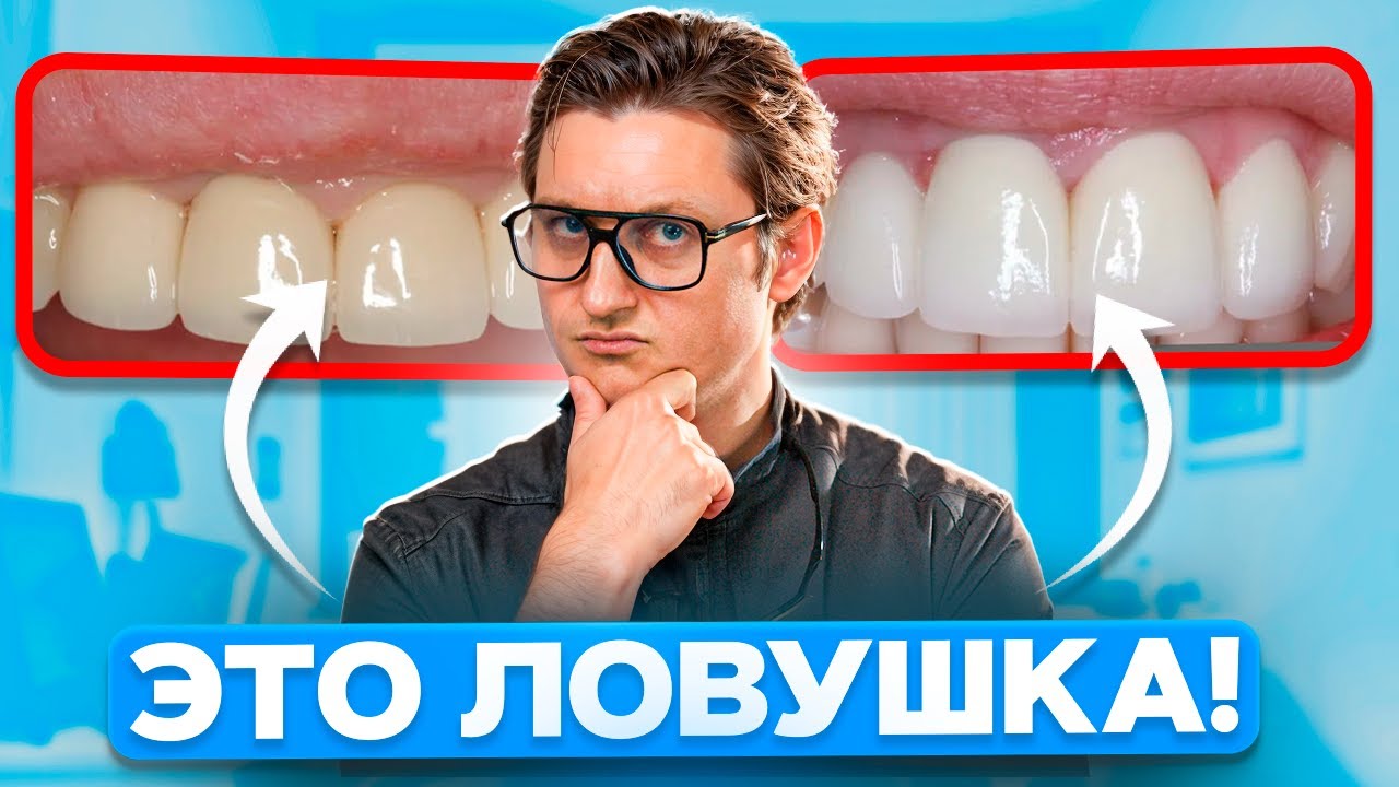 МЕТАЛЛОКЕРАМИКА или ЦИРКОНИЙ? Какие коронки выбрать в 2025 году?