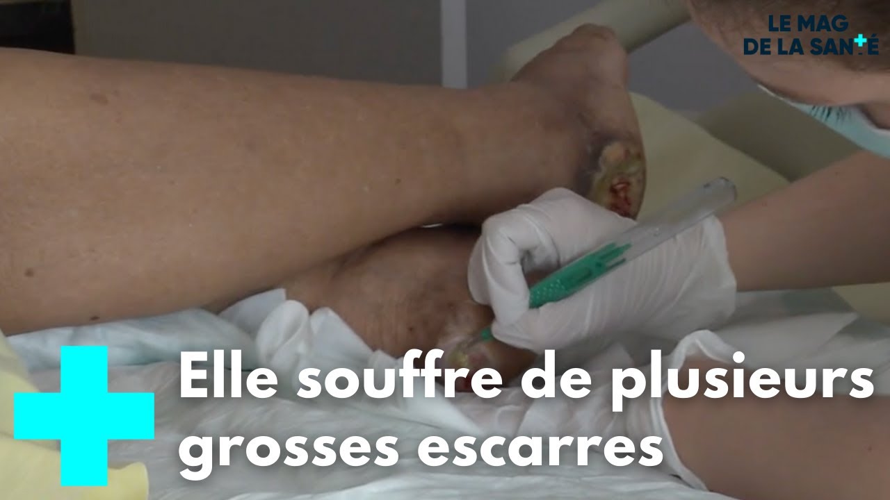 Comment soigner les escarres ? - Le Magazine de la Sant&eacute;
