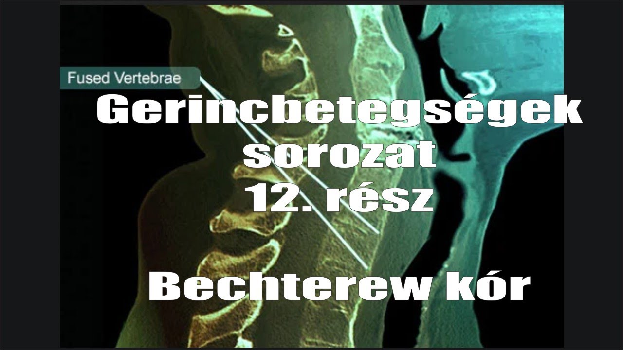 Gerincbetegségek sorozat 12. rész: Bechterew kór