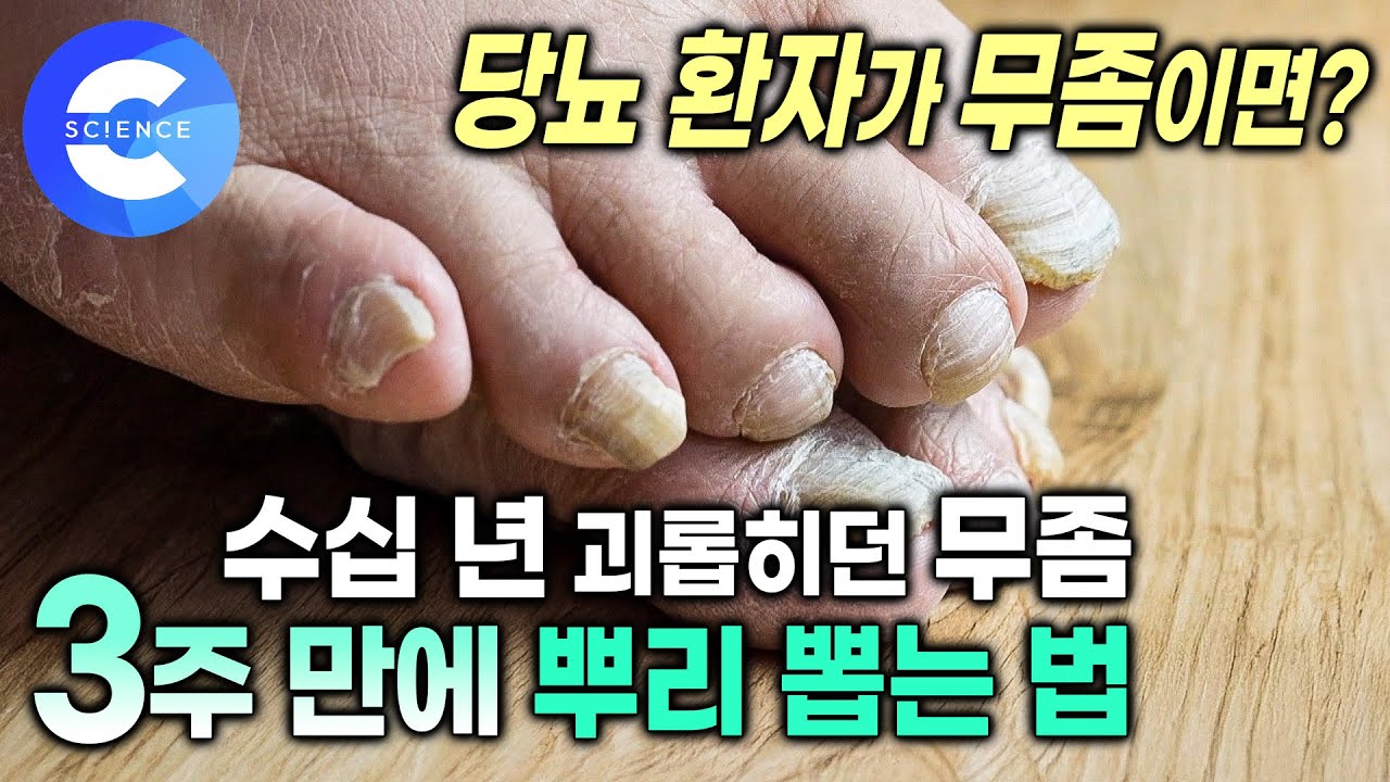무좀약 많이 바르면 오히려 안 좋다고? 15년째 고생한 무좀 3주 만에 싹 낫는 법 | 무좀 없애는 환경 | 귀하신몸