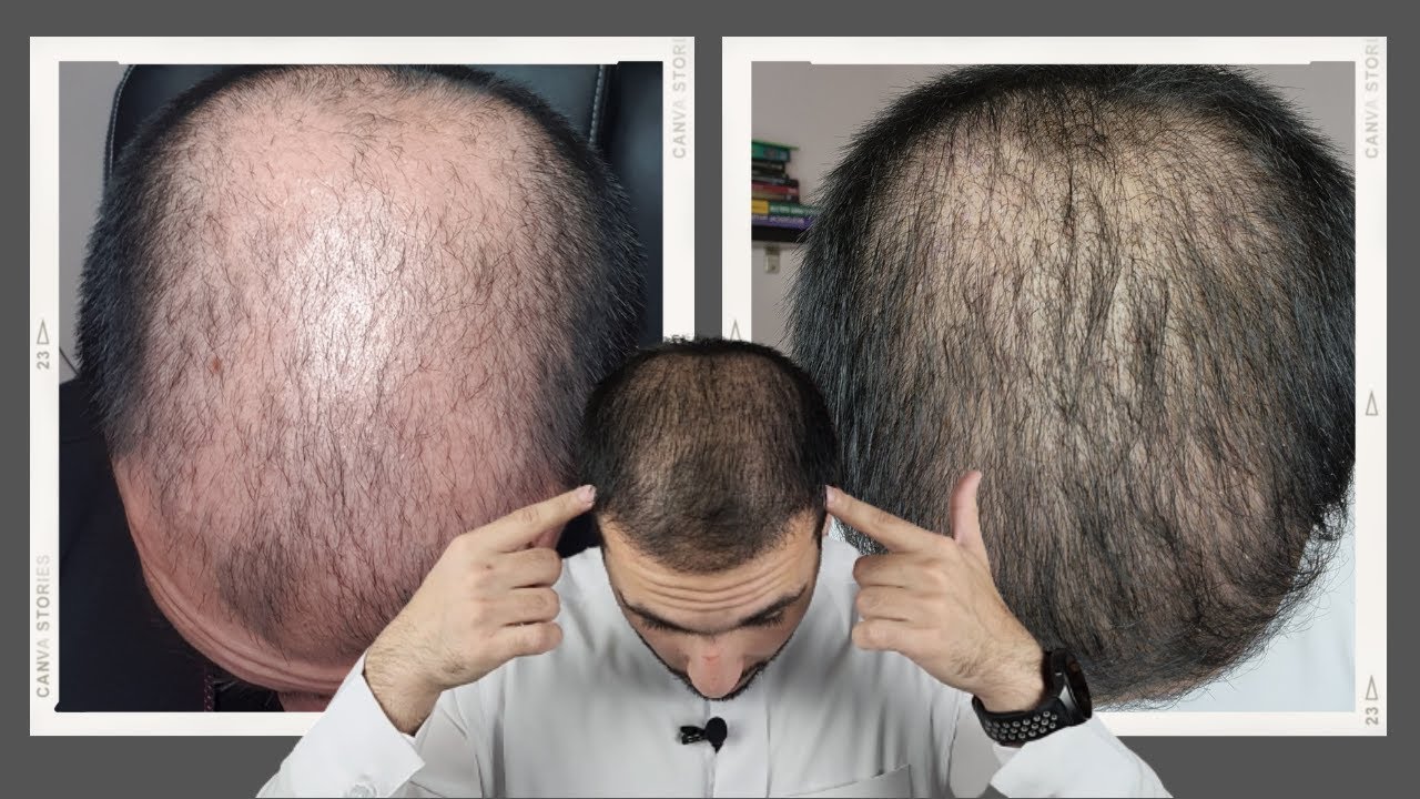 نتيجة الشهر الثالث من زراعة الشعر